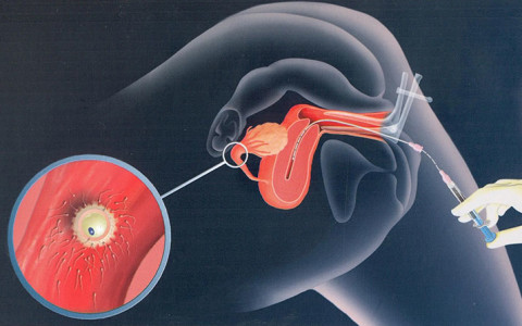 Inseminazione intrauterina (IUI)