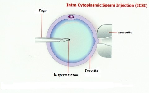 Iniezione intracitoplasmatica di spermatozoi (ICSI)