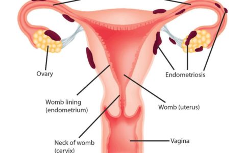 COS’È L’ENDOMETRIOSI?