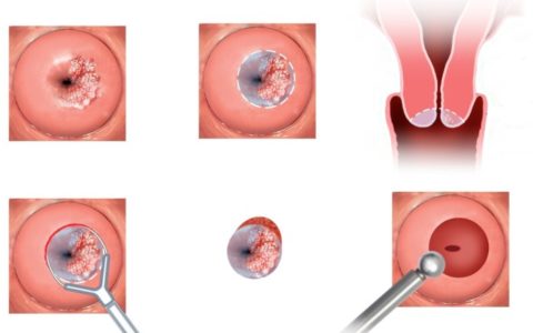 Tumori al collo dell’utero: il test del DNA ✿