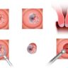 Tumori al collo dell’utero: il test del DNA ✿