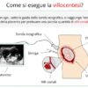 Villocentesi in Gravidanza: Utilità, Benefici e Considerazioni