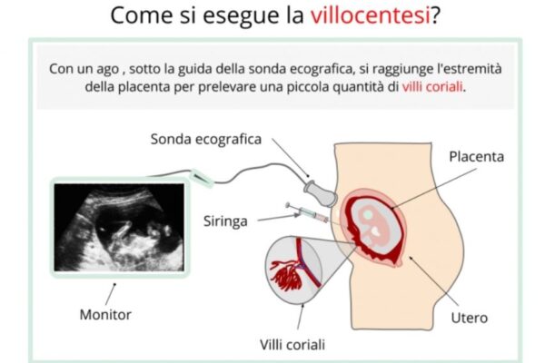 Villocentesi in Gravidanza: Utilità, Benefici e Considerazioni
