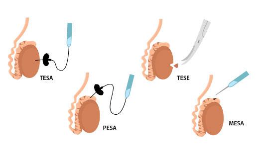 Tecniche di Recupero Chirurgico degli Spermatozoi (TESA, TESE, MESA, PESA)